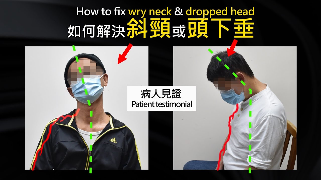 如何解決斜頸或頭下垂 How to fix wry neck & dropped head (3d 動畫) (N05)