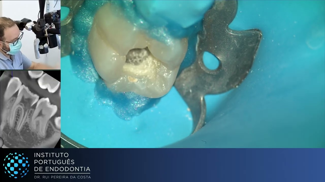 🦷36 with Cervical Root Resorption | NP ▶️ Part 2 | CASE335