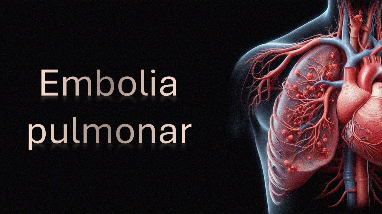 Embolia pulmonar