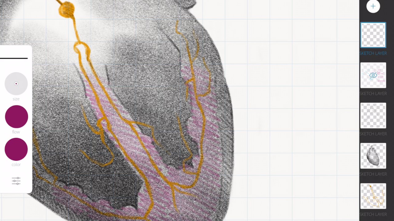 Infarto agudo de miocardio: Elevación o no del ST