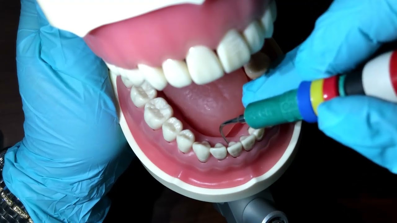 Ultrasonic tooth #25