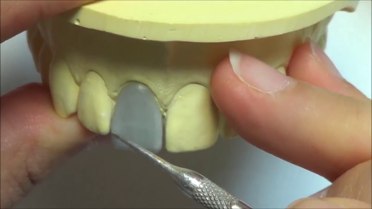 Live wax up   Upper central incisor