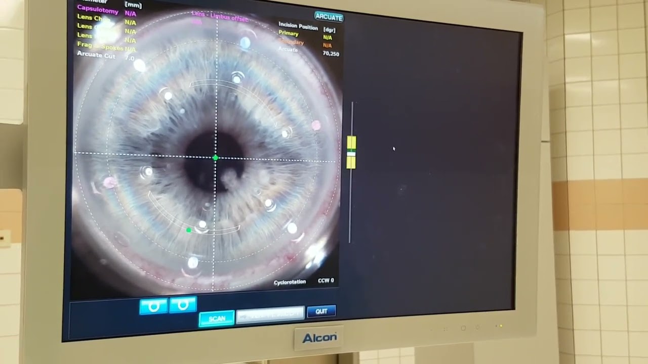 Femtosecond laser-assisted astigmatic keratotomy