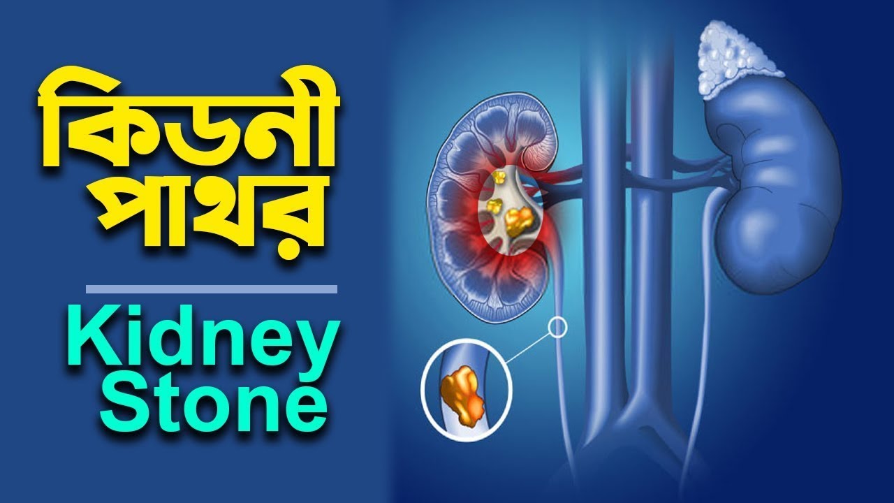 Kidney stones - Symptoms, causes, types, and treatment