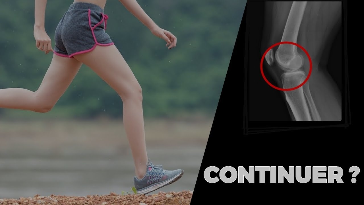 J'ai de l'arthrose de genou. La course à pied, c'est fini pour moi ?