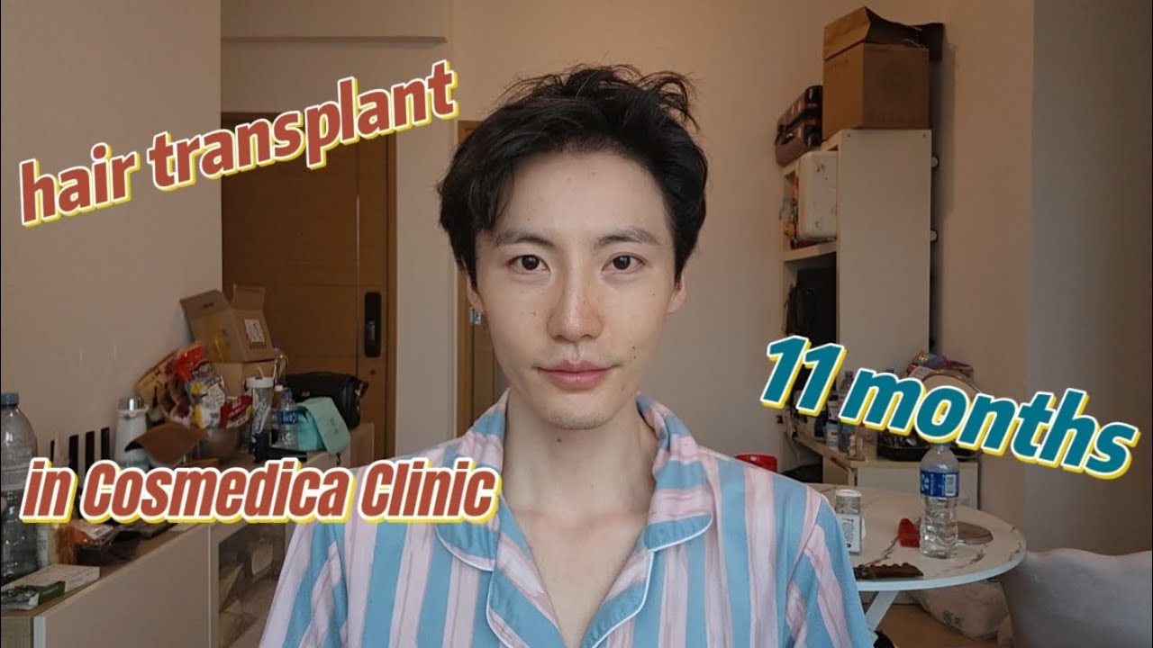 hair transplant in Cosmedica Clinic in Istanbul, month 11 #fue #hairtransplant #hair#haircare