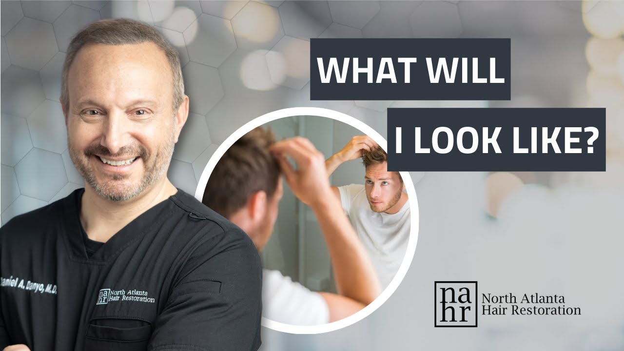 What Does A Beard To Head Hair Transplant Look Like?