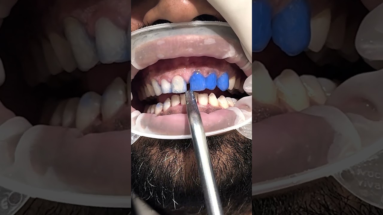 Achieving perfection with digital smile designing technology