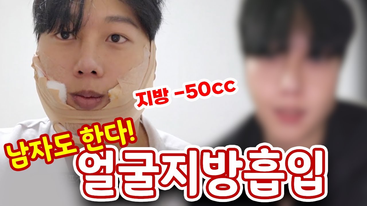 남자도 얼굴지방흡입 합니다! | 흘러내리던 얼굴 깔끔하게 정리했어요 | 디마레