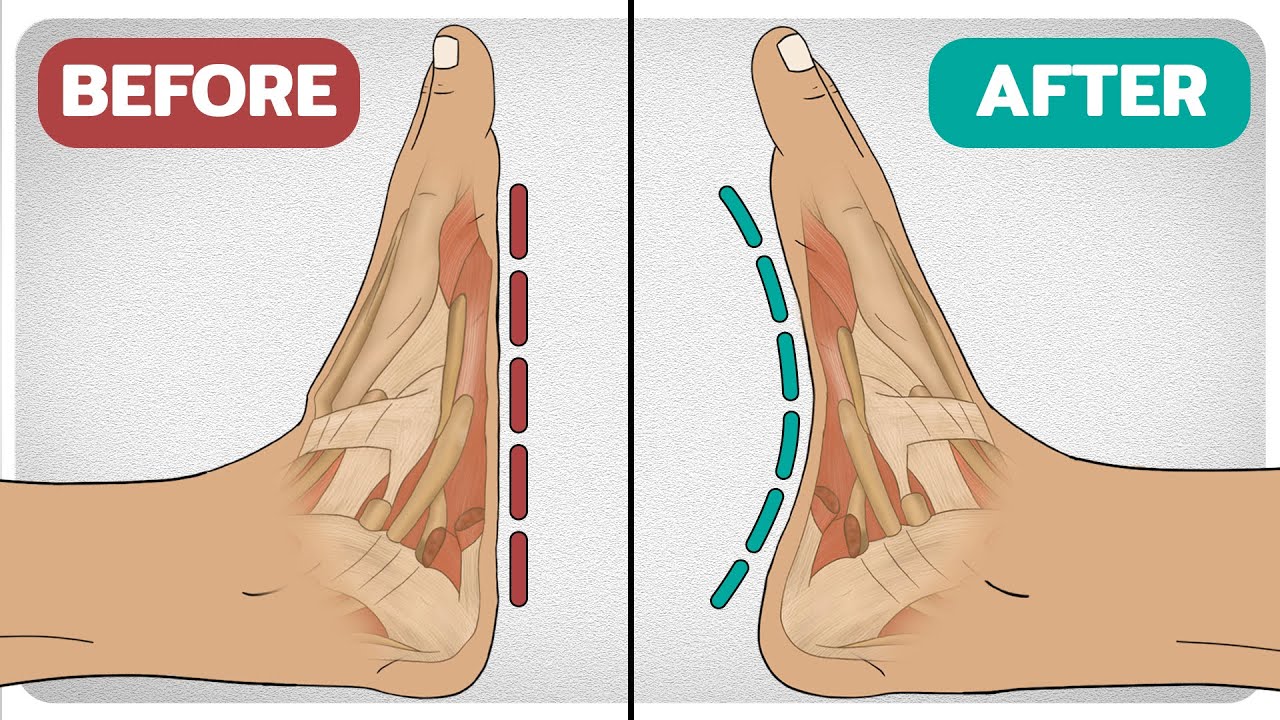 5 Exercises To Fix Flat-Feet (Fallen Arches)