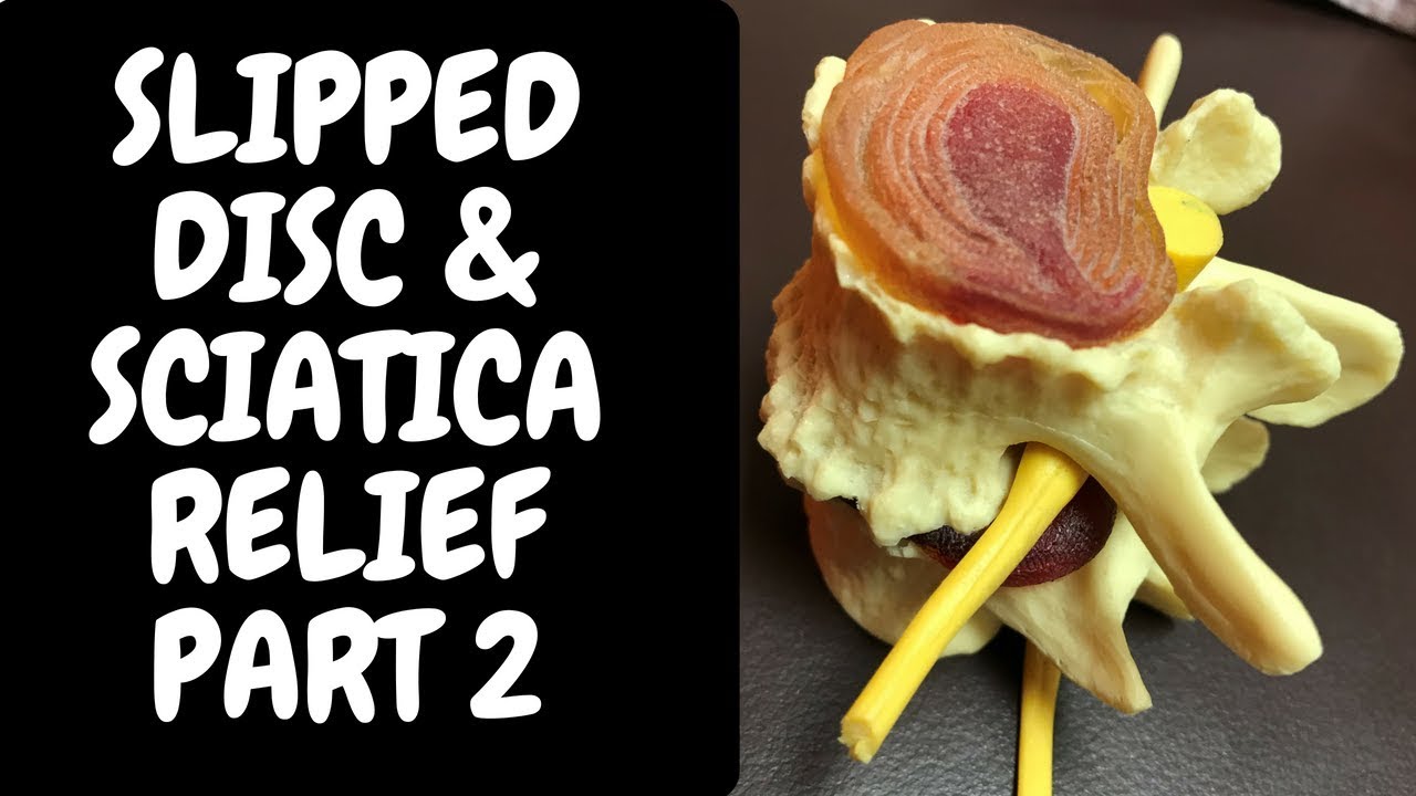 Slipped Disc & Sciatica Relief 2 - Calgary Chiropractor Chiropractical