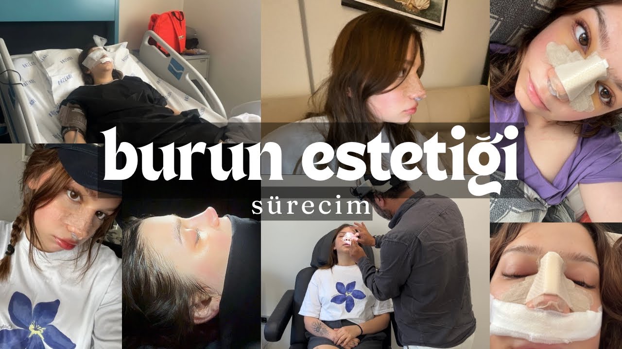 burun estetiği vlog | tüm süreç, en doğru kararım 