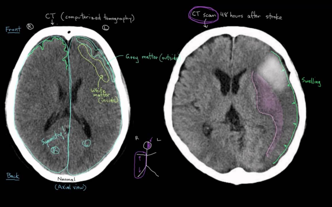 Khan Academy - Diagnosing Strokes with Imaging (CT, MRI, and Angiography)