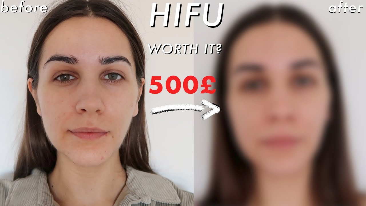 I'VE DONE NONSURGICAL FACE-LIFT AT 25 | BEFORE AND AFTER | WORTH IT? HIFU