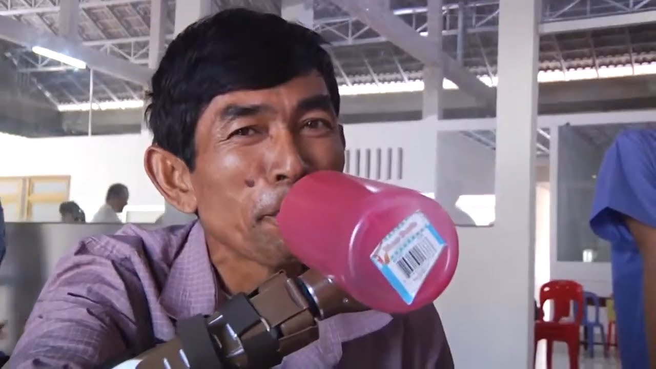 The Cambodian Journey with the LN-4 Prosthetic Hands