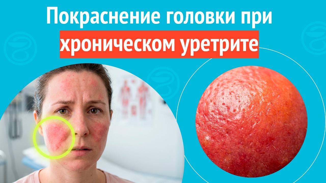 😡 Покраснение головки при хроническом уретрите. Клинический случай № 1733