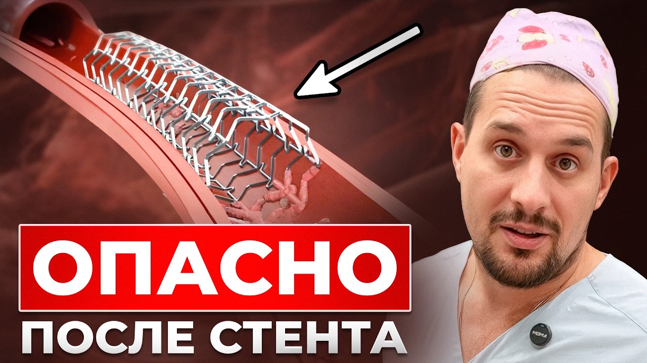 Есть ли жизнь после СТЕНТА | узнай сколько тебе осталось #всеососудах