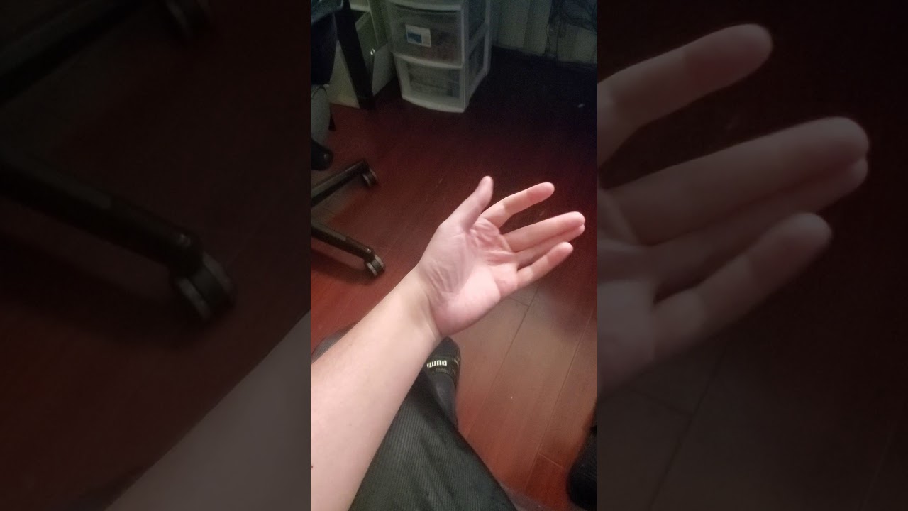 Final Update (Almost 3 Years) | PRC Surgery