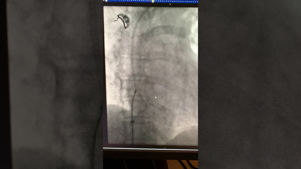 Snaring a Fractured Port Catheter