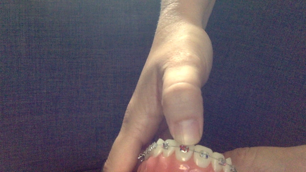 How to Fix Your Braces Ligature Tie Yourself  