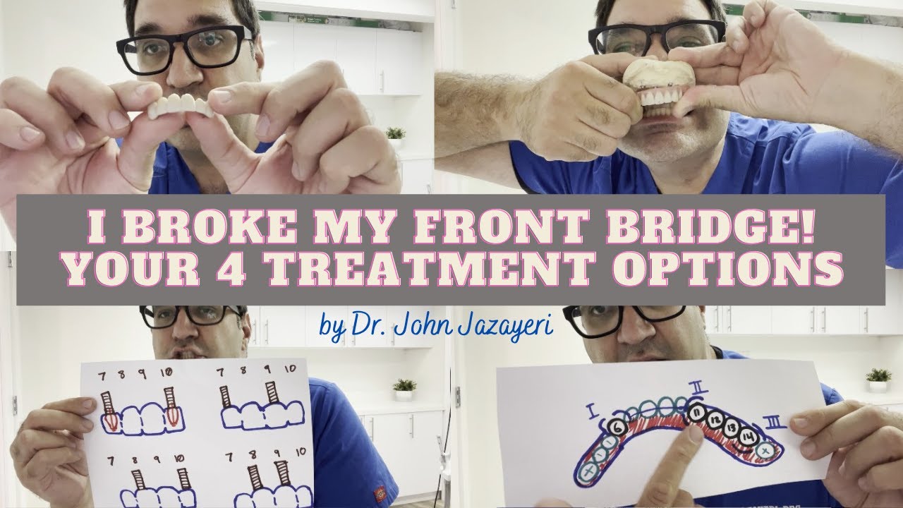 I Broke My Front Bridge: New Bridge vs Partial Denture vs Dental Implants vs All-on-4