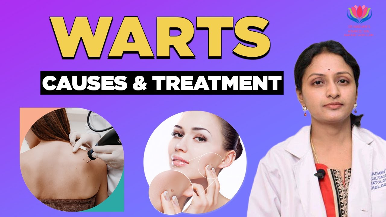 Warts - Causes & Treatment | Dr.Madhavi's Advanced Skin Hair and Laser Clinic