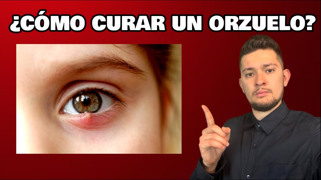 ✅ &iquest;C&oacute;mo CURAR un ORZUELO R&Aacute;PIDO? | ELIMINA un ORZUELO en el OJO