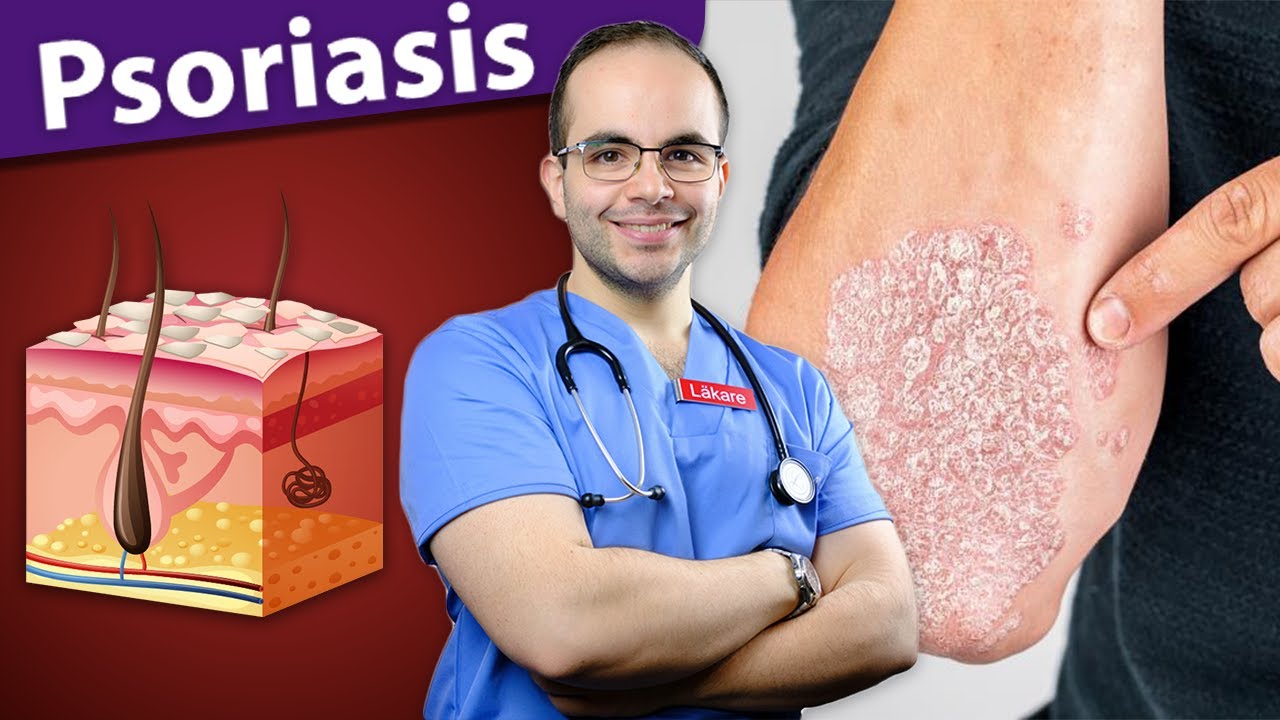 Psoriasis علاجات حديثة وفعالة لمرض الصدفية - الأسباب والأعراض والعلاج | معلومات هامة -طبيب في السويد
