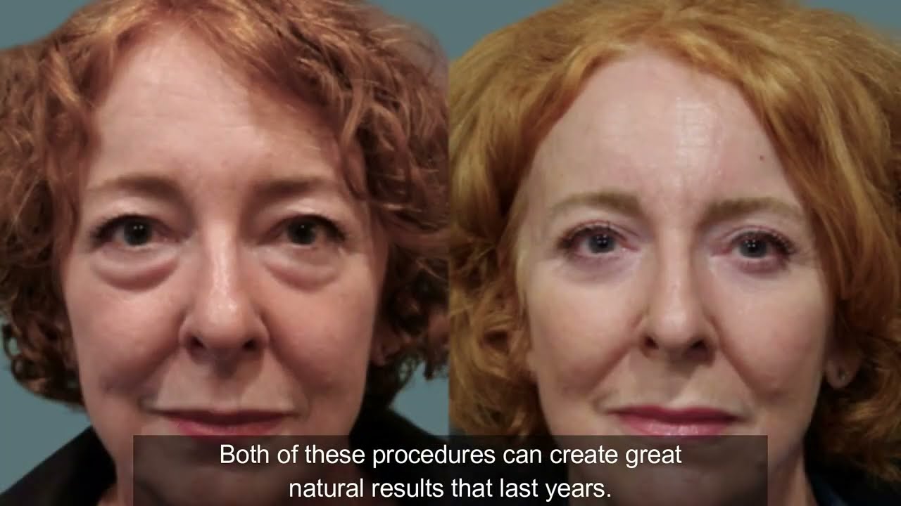Dr. Joseph Discusses Lower Eyelid Surgery | Lower Eyelid Blepharoplasty