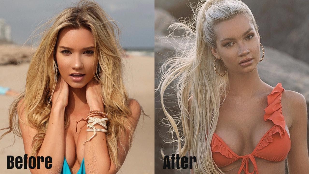 My Lip Injection Journey - Why I Do It A Different Way