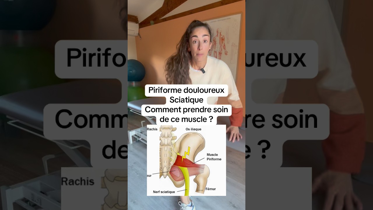 Piriforme douloureux - Sciatique