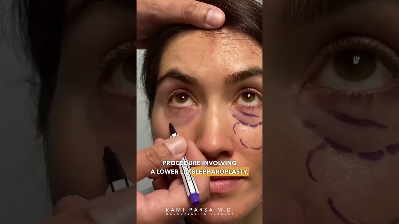 Dissolving Tear Trough Filler Before Trifecta Lift with Dr. Kami Parsa | Beverly Hills