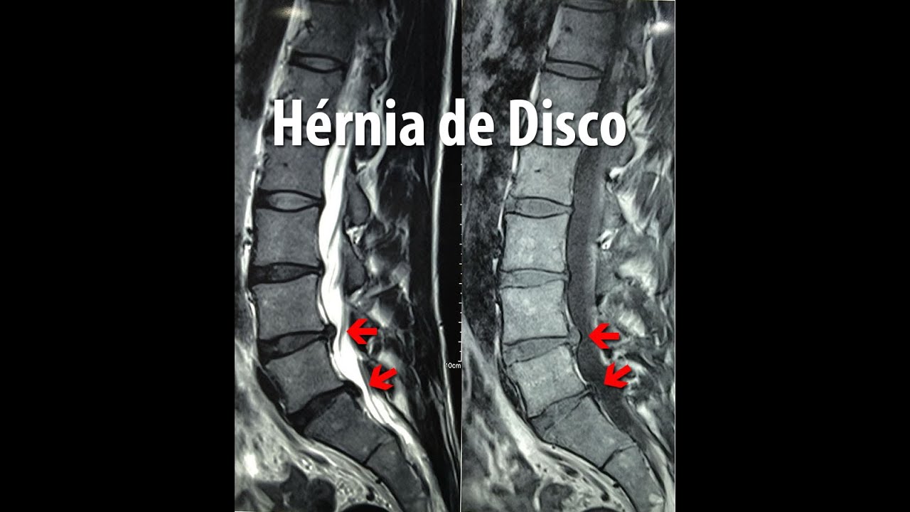 Hérnia de Disco e Lesões Discais