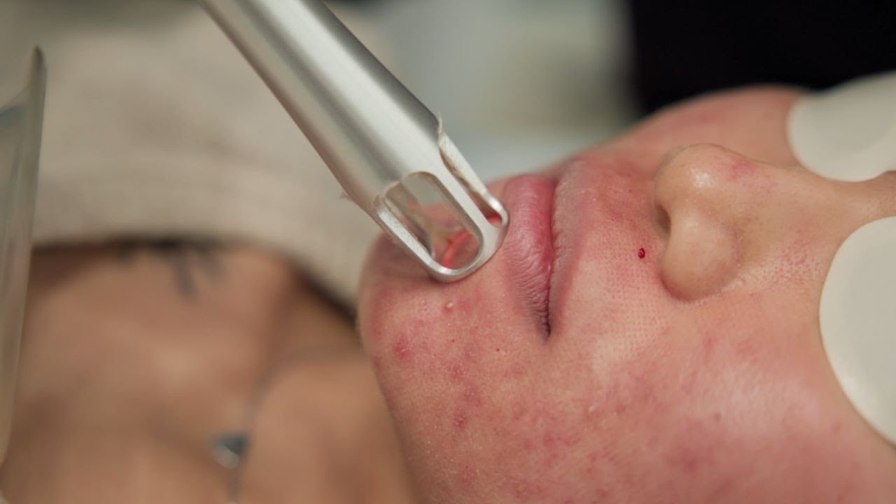 See the UltraClear Laser Experience: Real People, Real Reactions, Real Confidence!!!