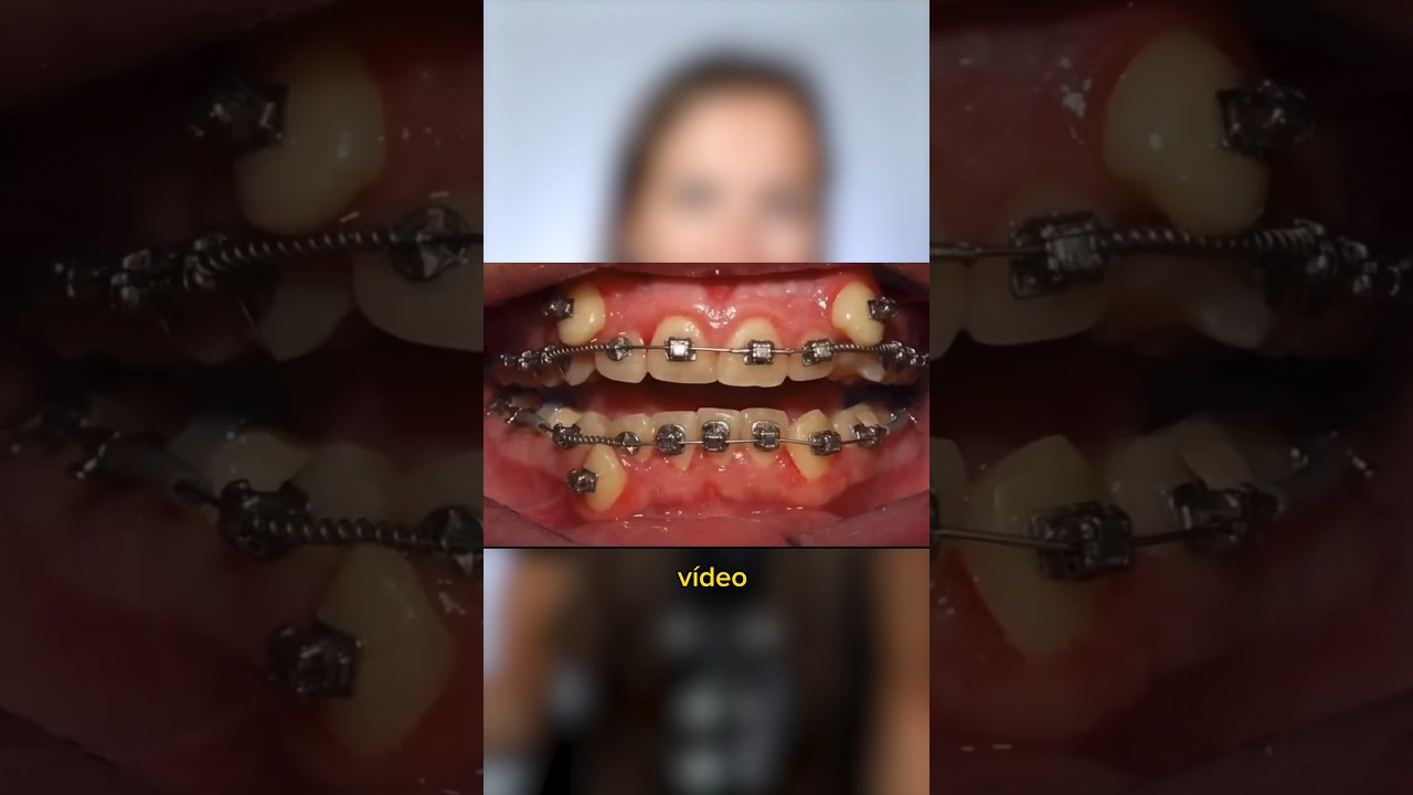 Si tienes los dientes muy API&Ntilde;ADOS, este time lapse de brackets te va a INTERESAR