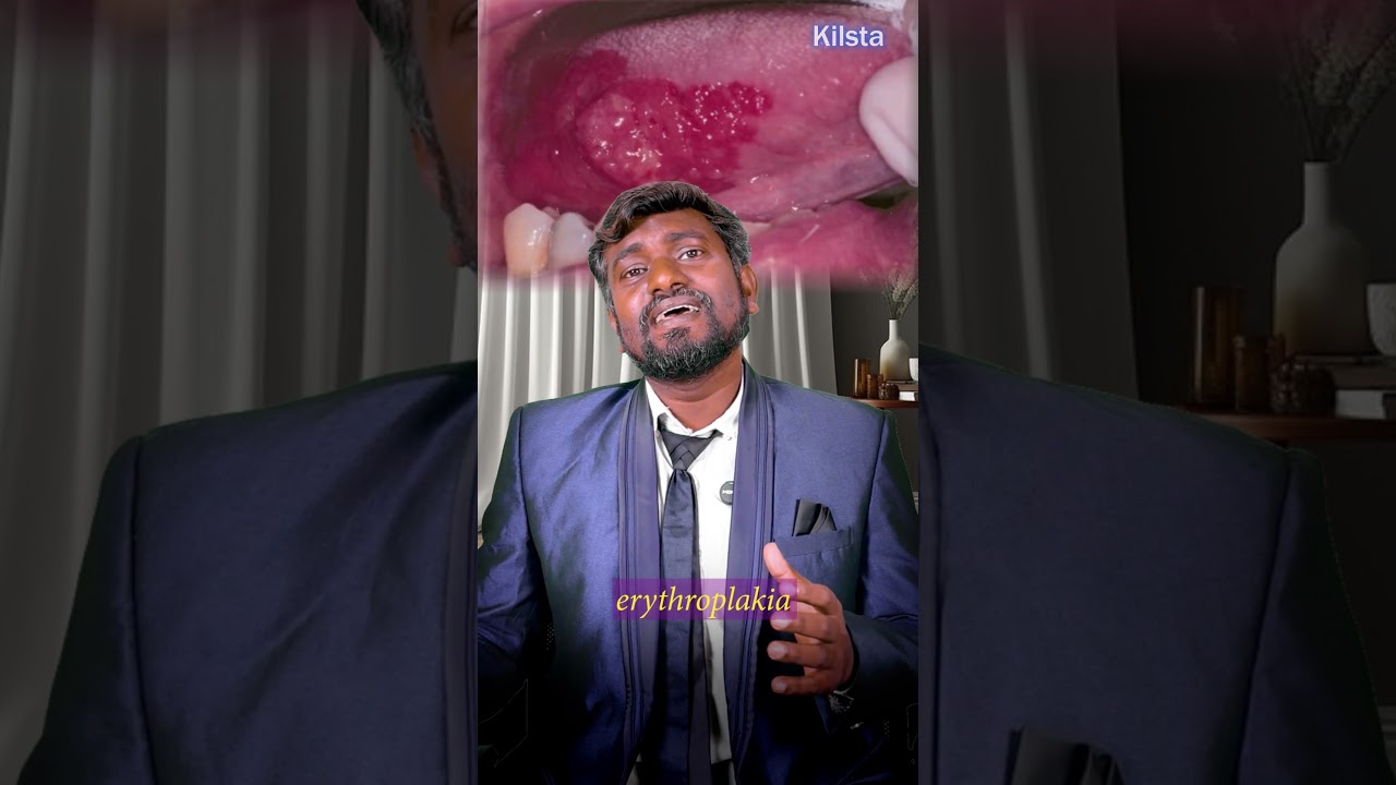 Oral Cancer & Lung Cancer | Internal Medicine | FMGE | Dr. Auroraj  #fmge2024 #fmgeaspirant  #fmge