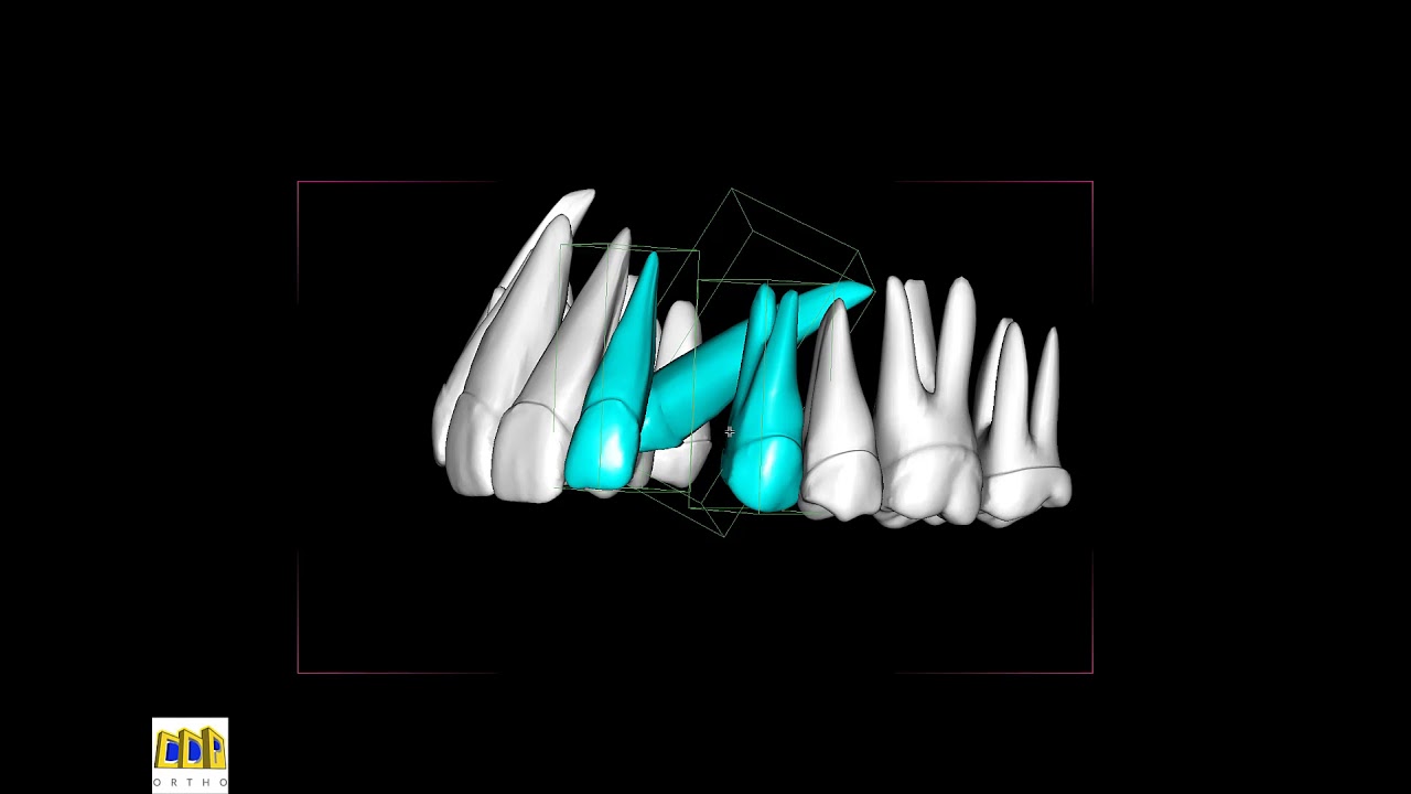 Impacted canine movement in orthodontics
