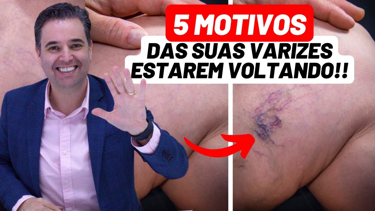 5 motivos das varizes estarem voltando após um procedimento! - Dr. Alex Vascular