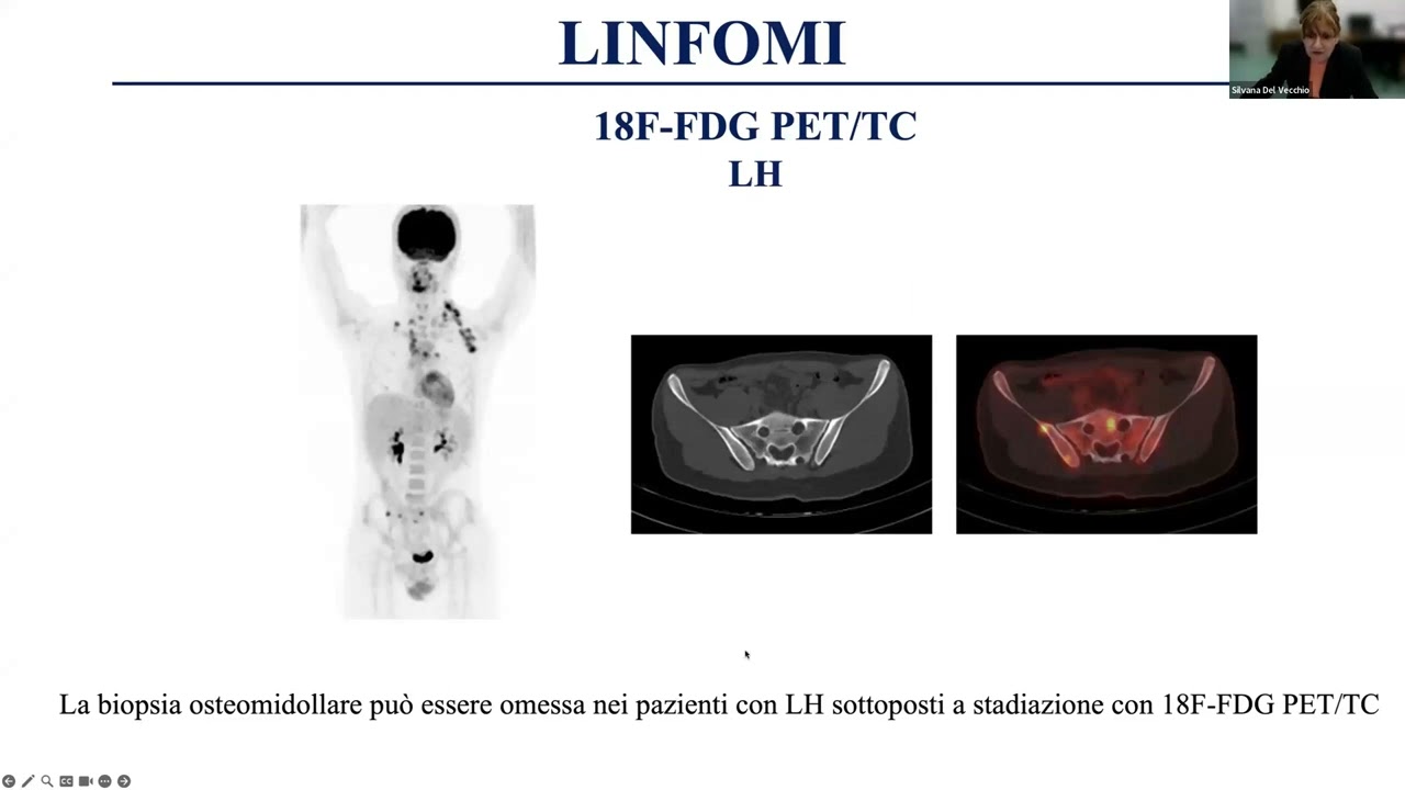 23.14) Le patologie oncologiche ematiche - Prof.ssa Del Vecchio e Prof. Cuocolo