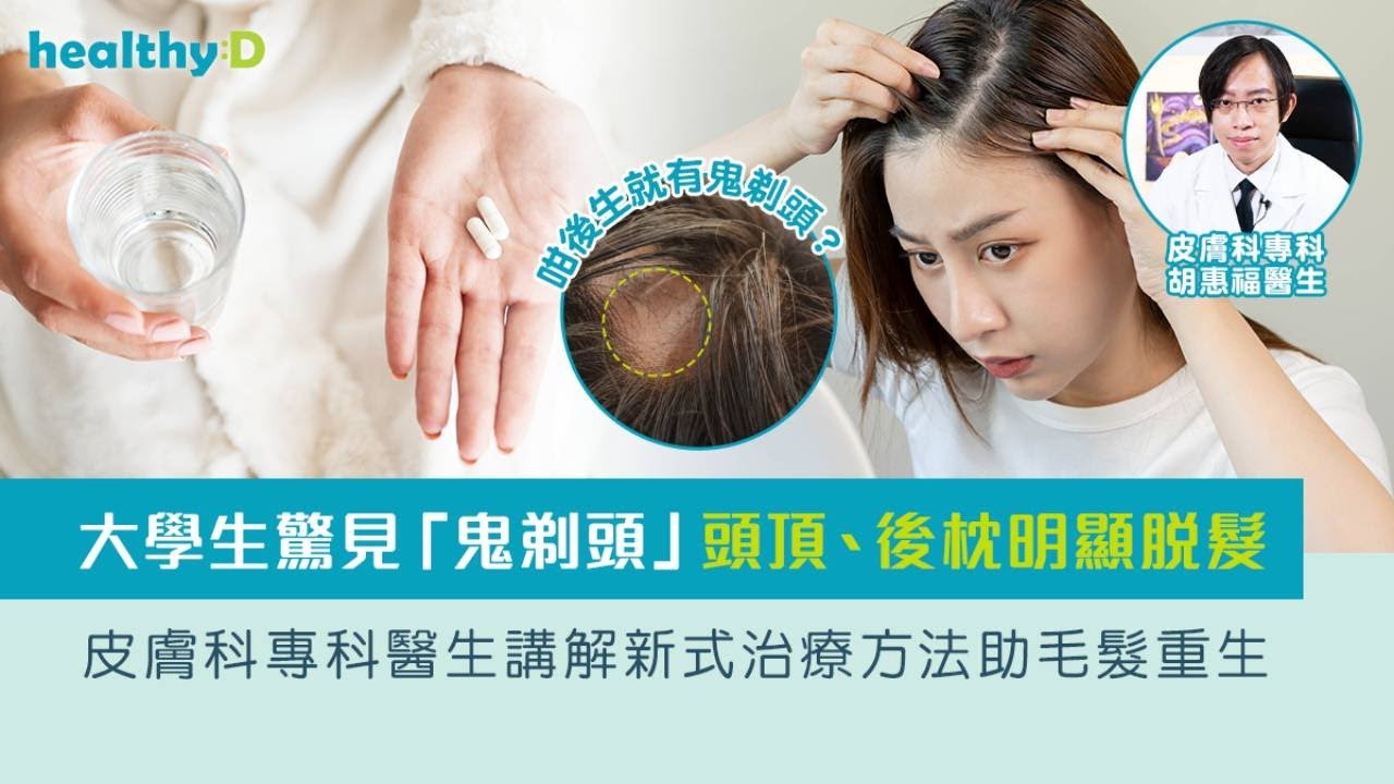 鬼剃頭(斑禿)｜年青女生都會突然甩頭髮！了解最新治療方法  加快頭髮重生