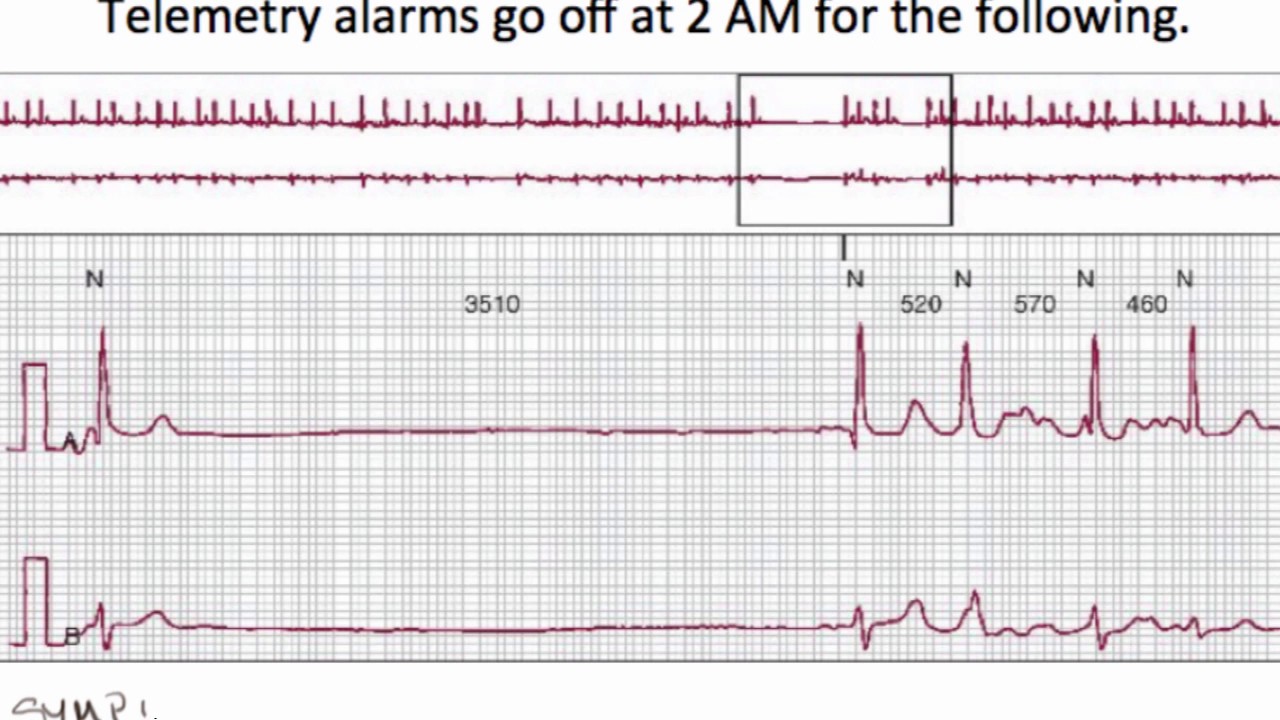 Causes and management of atrial fibrillation and bradycardia