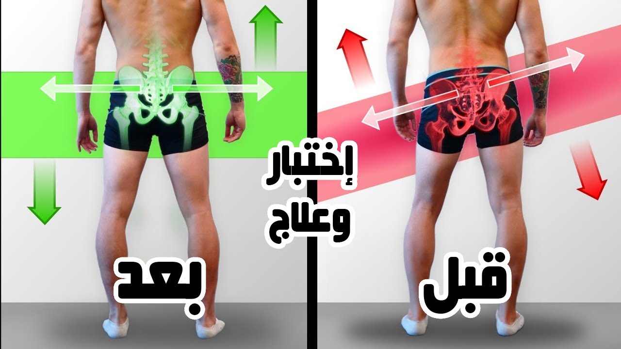 تصحيح ارتفاع الورك || علاج ميلان الحوض || الترنح أثناء المشي