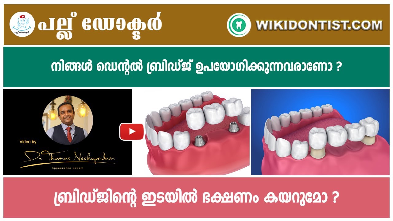 ബ്രിഡ്ജിന്റെ ഇടയിൽ ഭക്ഷണം കയറുമോ ?