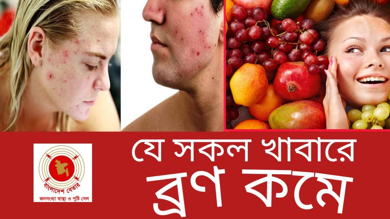 যে সকল খাবারে ব্রণ কমে Foods that Reduce Acne