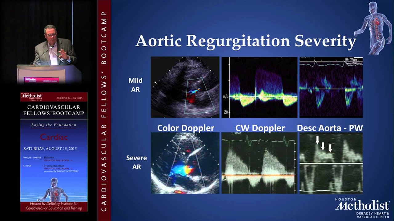 Aortic Regurgitation (Miguel Quiñones, MD)