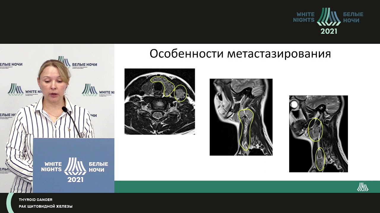 Возможности МР диагностики у пациентов с раком щитовидной железы (Пономарева О.И.)