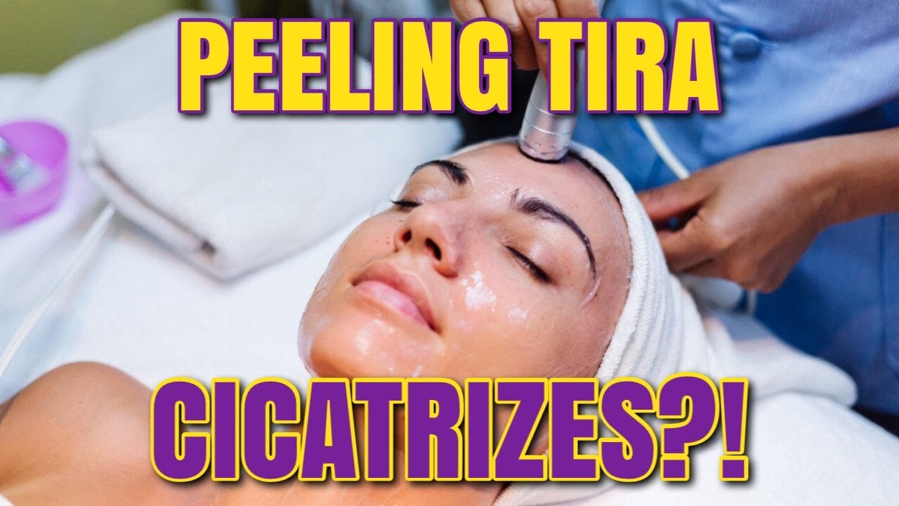 PEELING DE CRISTAL X PEELING DE DIAMANTE - Qual Melhor para MANCHAS E CICATRIZES DE ACNE?