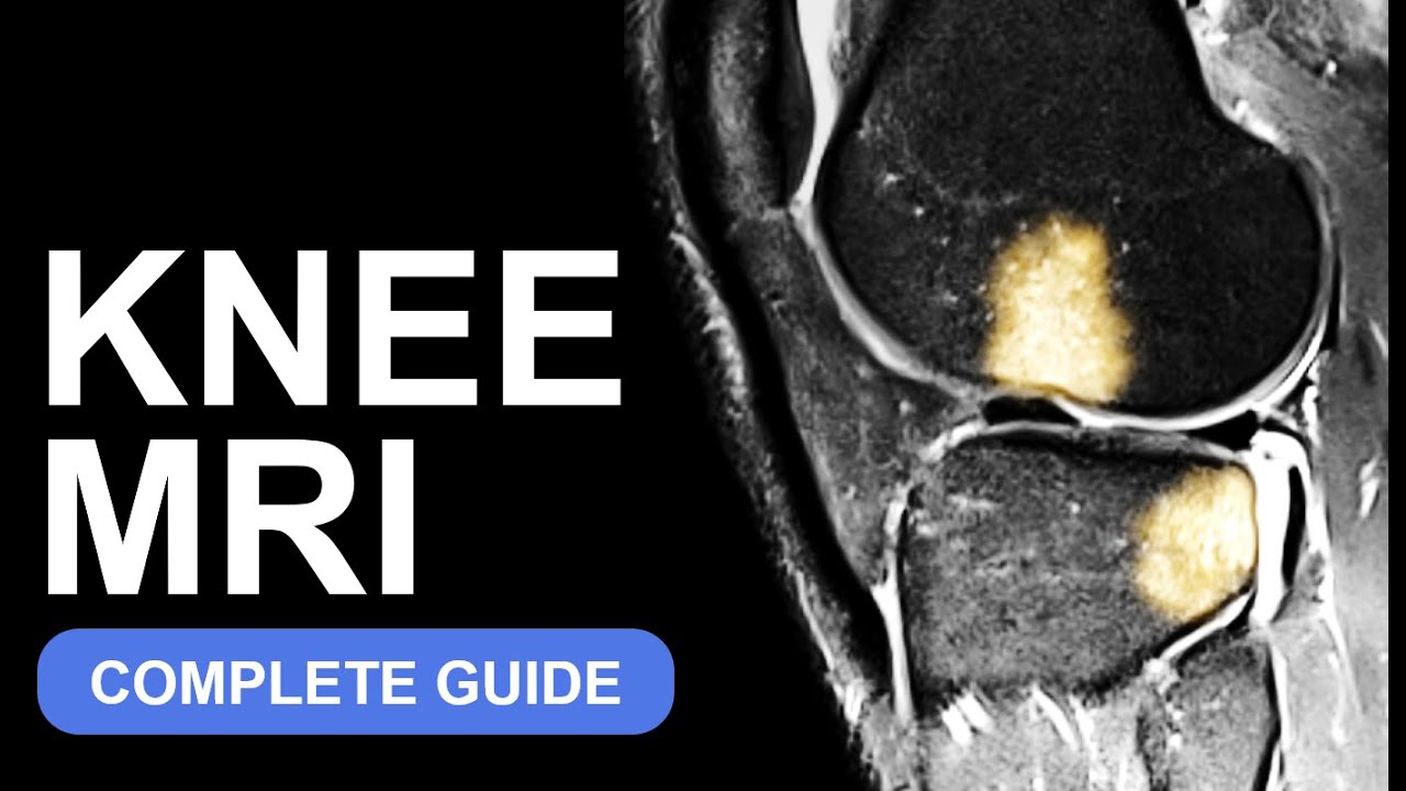 Knee MRI: The Ultimate Guide (Anatomy & What to Look For)