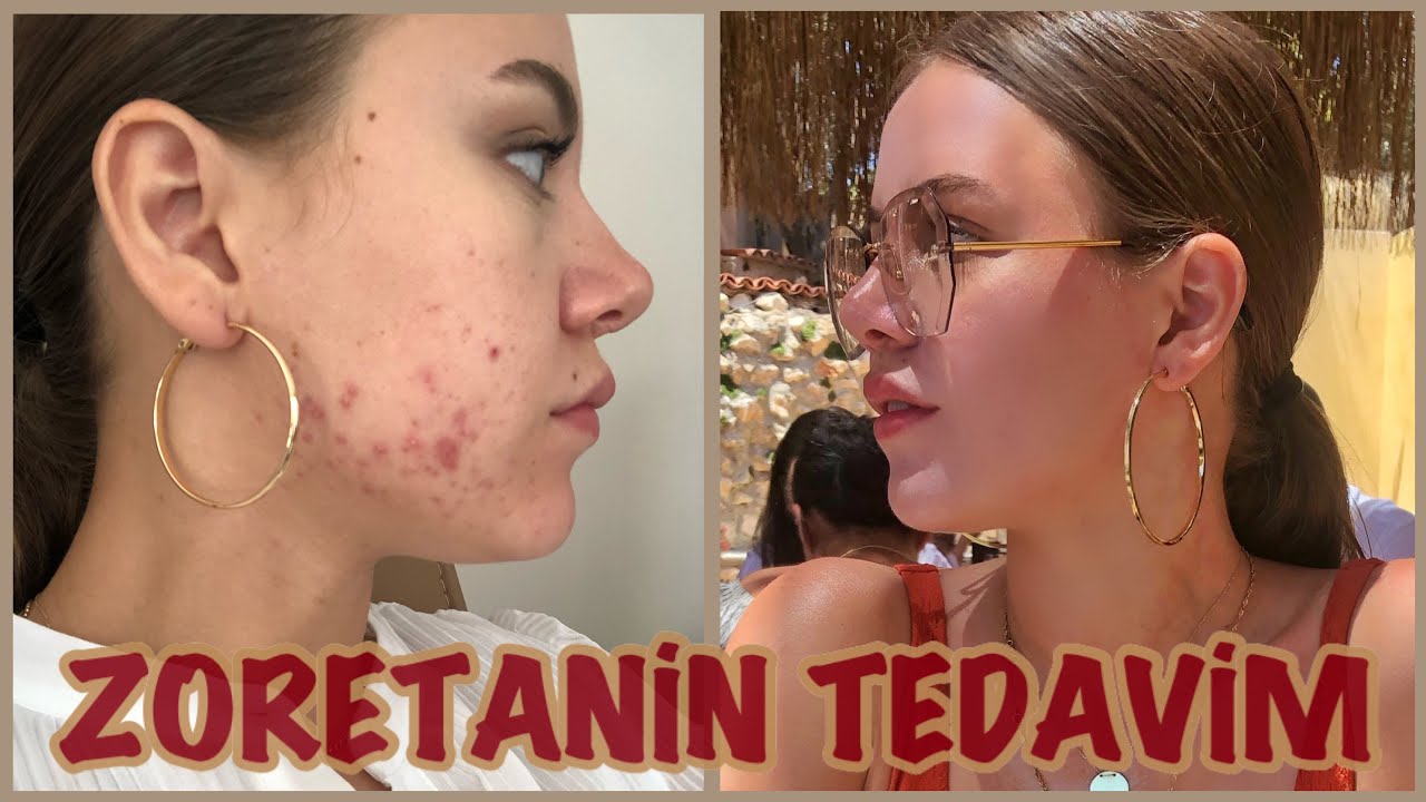 ZORETANİN TEDAVİM BİTTİ 🤩 SÜREÇ HAKKINDA NELER YAŞADIM , YAN ETKİLERİ ,  NELER KULLANDIM