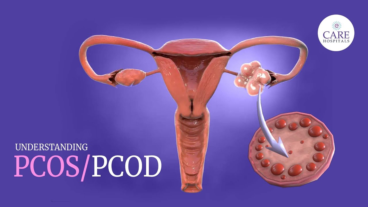 PCOS/PCOD: Symptoms, Causes, and Treatment | Menstruation Cycle